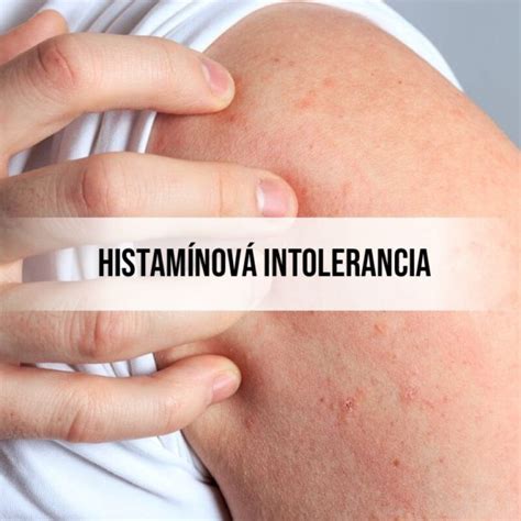 Histamínová intolerancia a jej symptómy