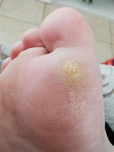 Cibuľa a cesnak ako domáce lieky na kurie oká