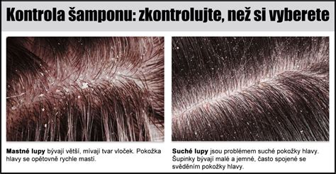 Suchá vs. mastná pokožka hlavy