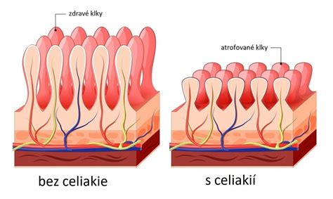 Schéma: Tenké črevo pri celiakii a bez celiakie