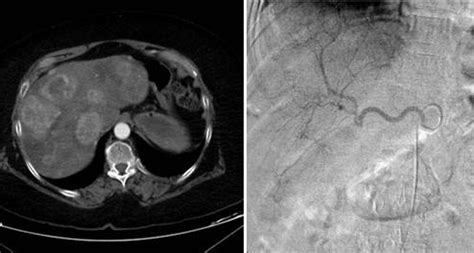 Schéma transarteriálnej chemoembolizácie