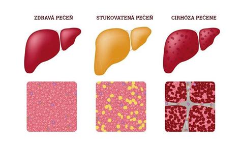 Vizualizácia štádií cirhózy pečene