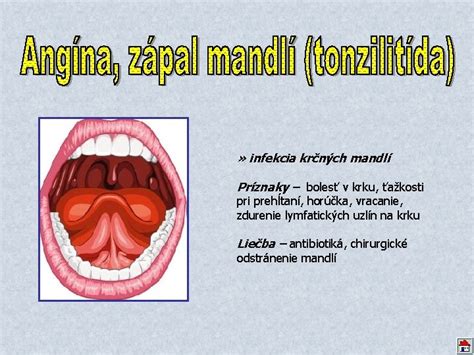 Schéma umiestnenia krčných a nosných mandlí v ľudskom hrdle