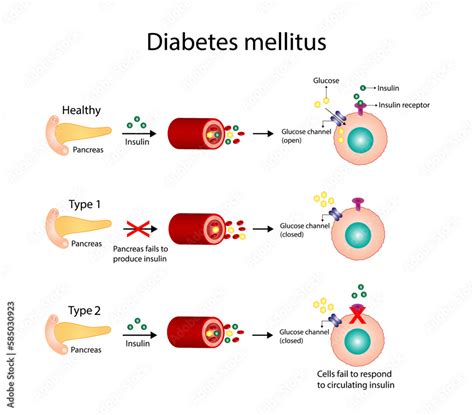 Infografika porovnávajúca diabetes mellitus 1. a 2. typu.