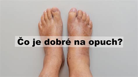 Príčiny opuchnutých nôh