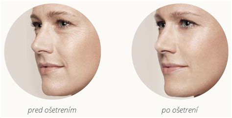 Porovnanie: Koža pred a po ošetrení