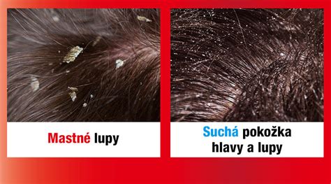 Mikroskopický pohľad na lupiny a zdravú pokožku hlavy