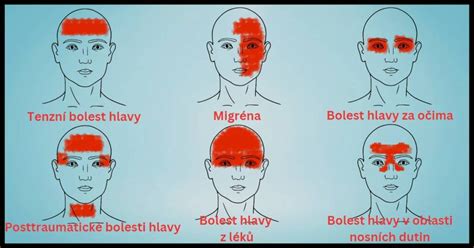 Lokalizácia bolesti hlavy pri rôznych typoch