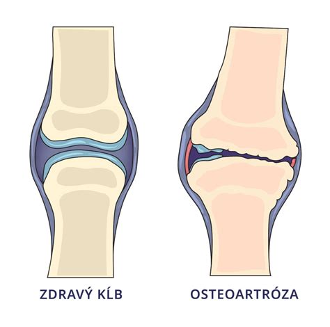 Schéma zdravého kĺbu verzus kĺb postihnutý artrózou