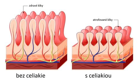 Ilustrácia poškodeného tenkého čreva pri celiakii
