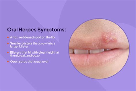 Herpes a kútiky: Rozdiely