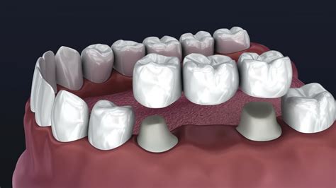zubný implantát vs. mostík