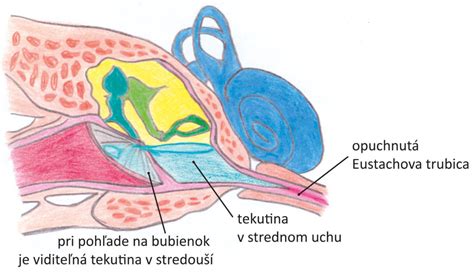 Infografika: Eustachova trubica a jej úloha pri zápale stredného ucha
