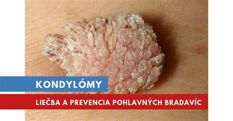 Genitálne bradavice - fotografia
