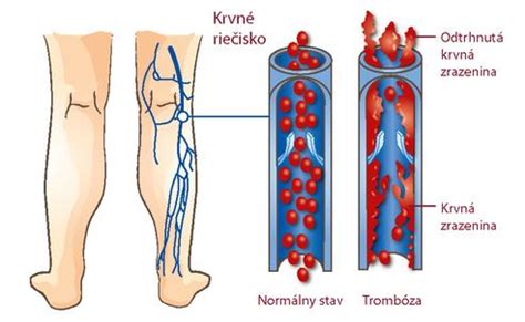 Infografika: Rizikové faktory hlbokej žilovej trombózy