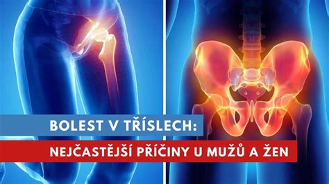 Mapa tela znázorňujúca typické oblasti bolesti stehna
