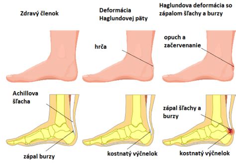 Nohy v nevhodnej obuvi s vyznačenými miestami častého vzniku kurieho oka