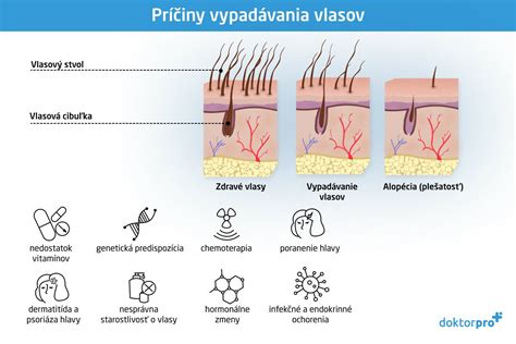 Ilustrácia znázorňujúca rôzne príčiny vypadávania vlasov u mužov