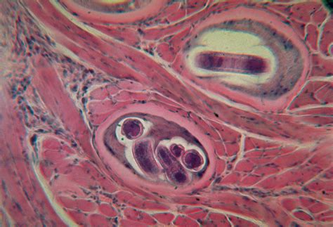 Trichinella spiralis larvy v svalovom tkanive