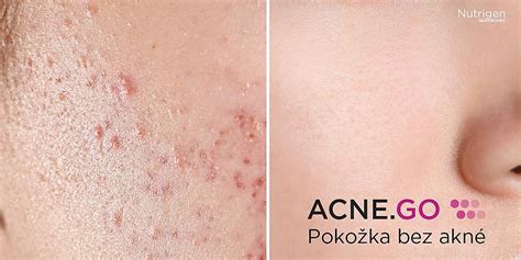 Pohľad na pokožku postihnutú akné