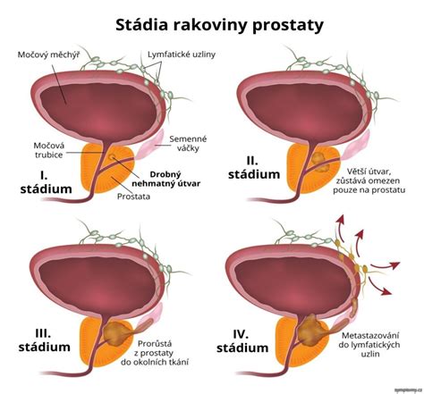 Schéma mužskej prostaty a močového systému