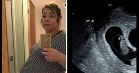 Ultrazvukový snímok žĺtkového vaku a embrya