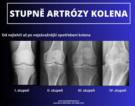 Röntgenová snímka kolena s príznakmi artrózy