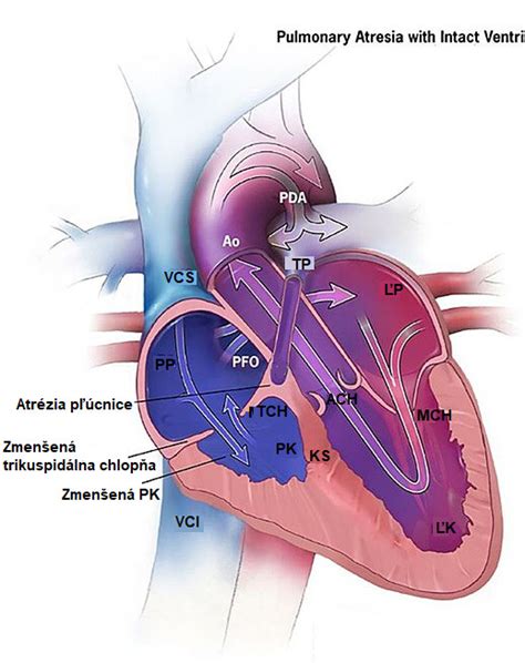 Diagram srdca s vyznačeným defektom komorového septa