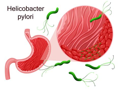 Schéma Helicobacter pylori v žalúdku
