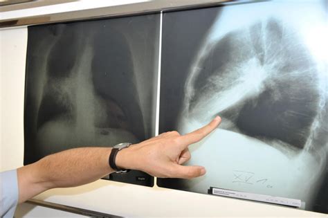 Röntgenový snímok pľúc s klíčiacim hráškom