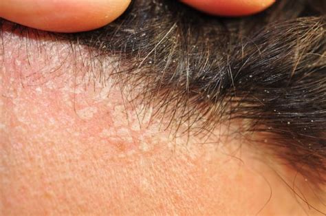 Prejavy seboroickej dermatitídy na vlasovej pokožke