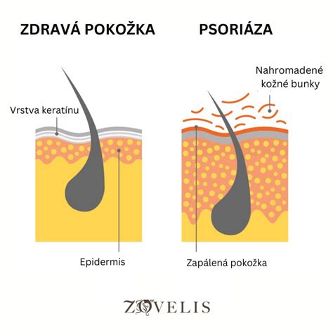Psoriáza na vlasovej pokožke