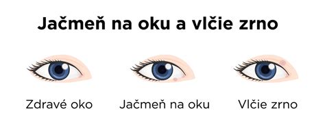 Jačmeň na oku