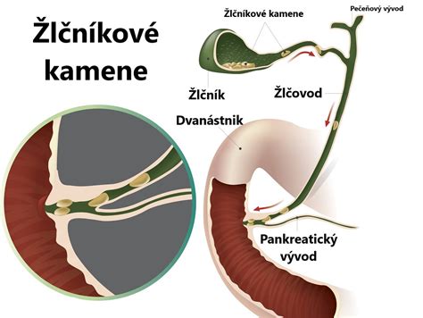 Žlčové kamene a ich súvislosť s čiernou reďkovkou