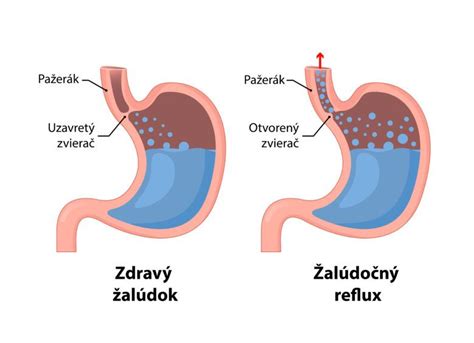 Schéma tráviaceho systému so zameraním na pažerák a žalúdok pri refluxe