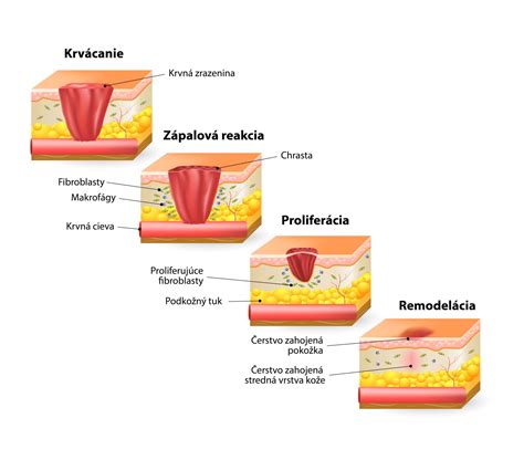 Infografika zobrazujúca proces hojenia po odstránení hemangiómu