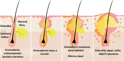 Schéma: Faktory ovplyvňujúce vznik akné
