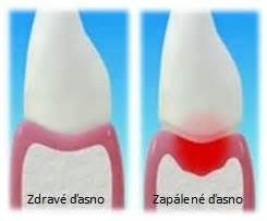 Zapálené ďasno