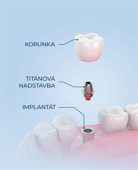 Vizualizácia zubného implantátu