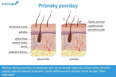 Príznaky psoriázy na rukách