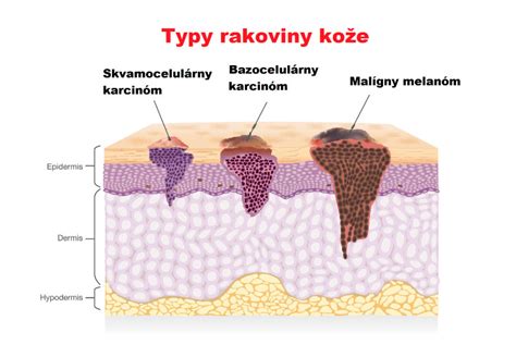 Rôzne typy kožných vredov
