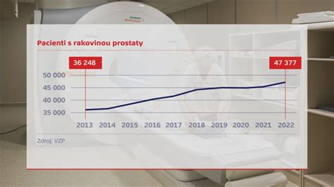 Graf prežívania pri rakovine pečene podľa štádií