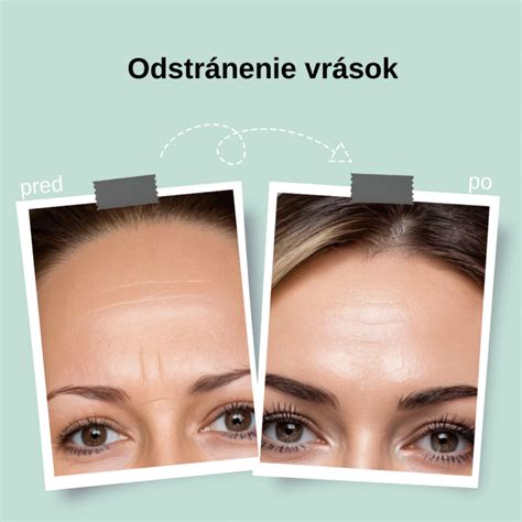 Príprava šampiňónov pred plnením: odstránenie nožičiek