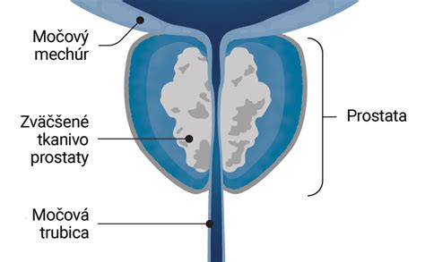 Ilustrácia zväčšenej prostaty a jej vplyvu na močovú trubicu