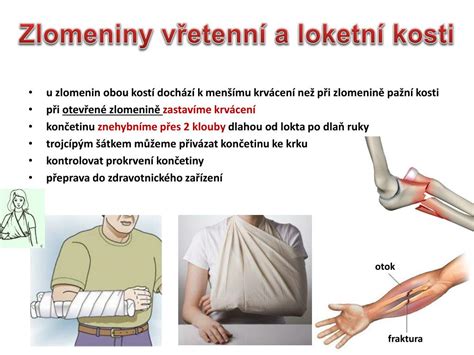 Ošetrenie zlomeniny končatiny