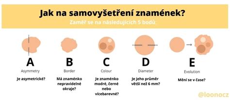 Schéma: ABCDE pravidlo pre samovyšetrenie znamienok