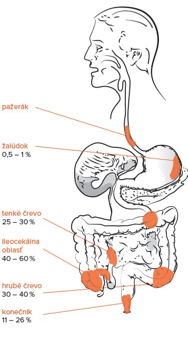 Ilustrácia procesu trávenia fazule v hrubom čreve a vzniku plynov.