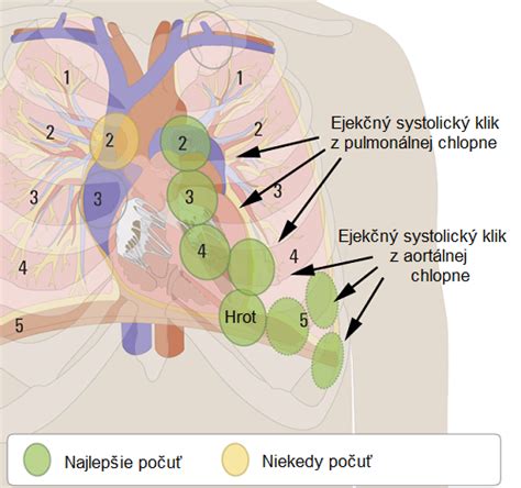 Schéma usadzovania vápnika v aortálnej chlopni