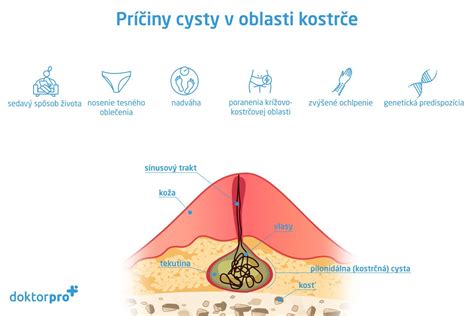 Ilustrácia laparoskopického zákroku pri odstraňovaní cysty