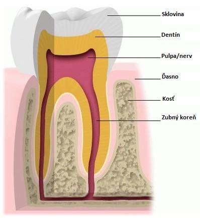 Schema zubného koreňa s fistulou